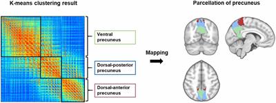 Simultaneous PET/fMRI Detects Distinctive Alterations in Functional Connectivity and Glucose Metabolism of Precuneus Subregions in Alzheimer’s Disease